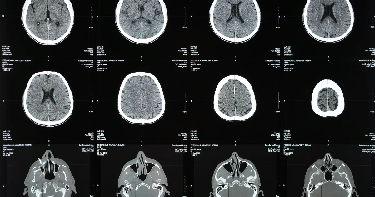an image of a brain scan